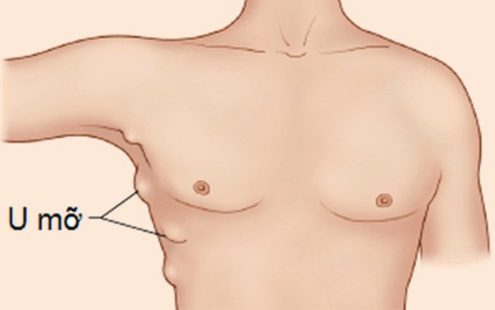 U mỡ xuất hiện ở bất kỳ vị trí nào trên bề mặt da hoặc bên trong cơ thể